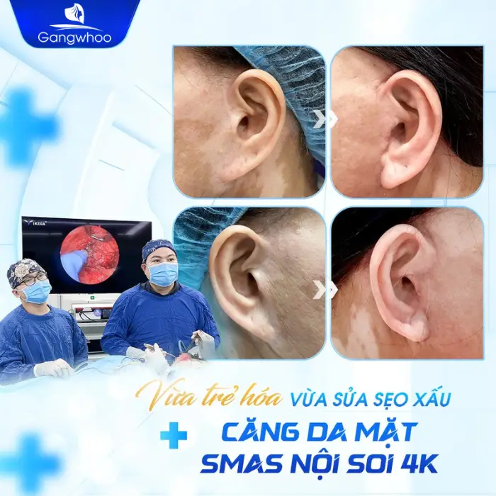 Căng da mặt nội soi ở đâu tốt? Gợi ý 5 địa chỉ uy tín