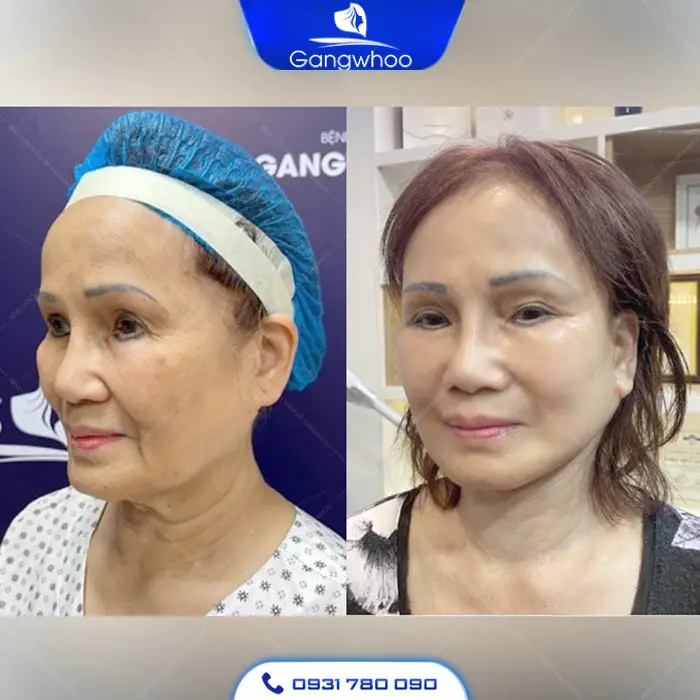 Căng Da Thái Dương SMAS – Giải Pháp Trẻ Hóa Vượt Trội Với Công Nghệ Hiện Đại Tại Thẩm Mỹ Viện Gangwhoo