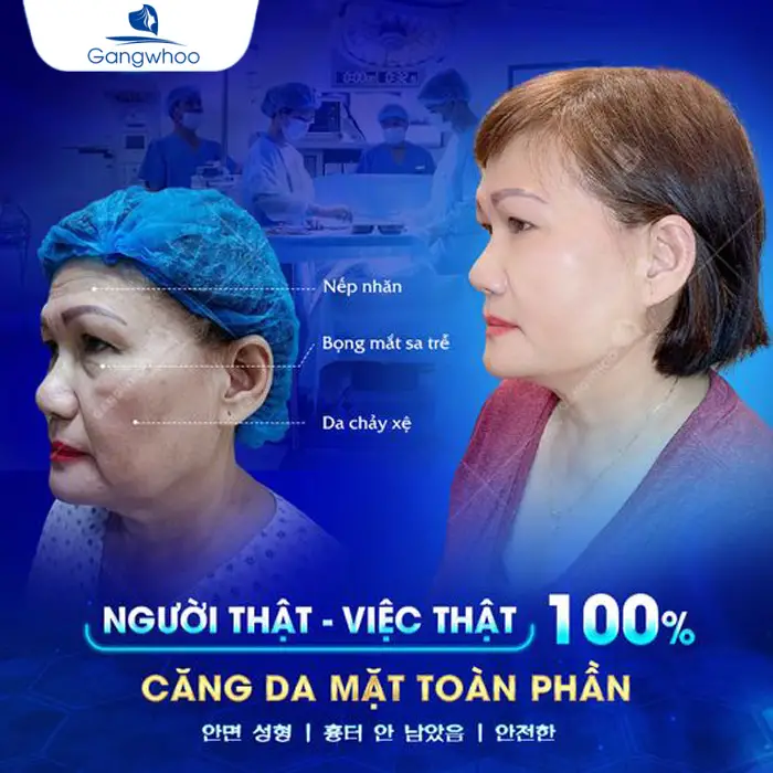 Căng Da Thái Dương SMAS – Giải Pháp Trẻ Hóa Vượt Trội Với Công Nghệ Hiện Đại Tại Thẩm Mỹ Viện Gangwhoo