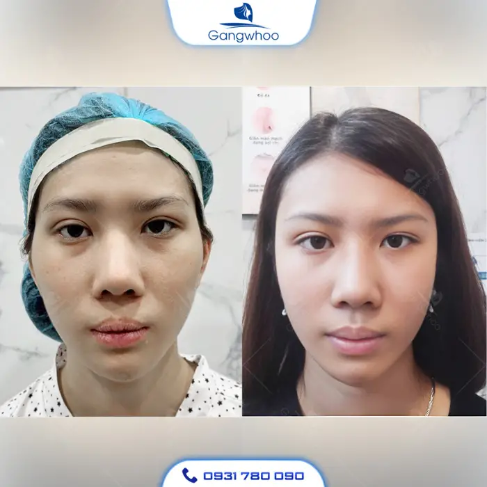 Căng Da Thái Dương SMAS – Giải Pháp Trẻ Hóa Vượt Trội Với Công Nghệ Hiện Đại Tại Thẩm Mỹ Viện Gangwhoo