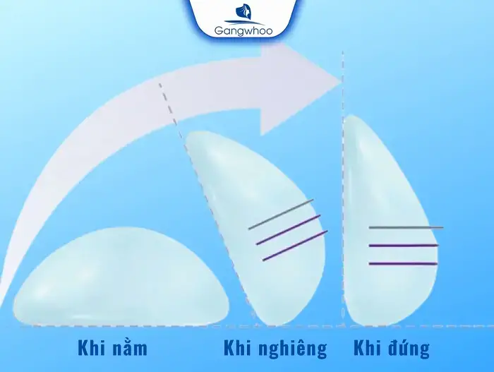 Túi nâng ngực Ergonomic (Motiva)