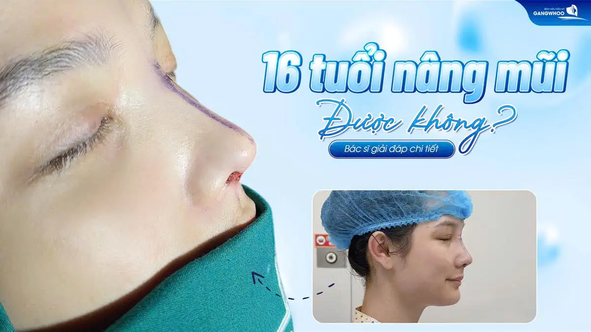16 Tuổi Nâng Mũi Được Không? Bác Sĩ Giải Đáp Chi Tiết