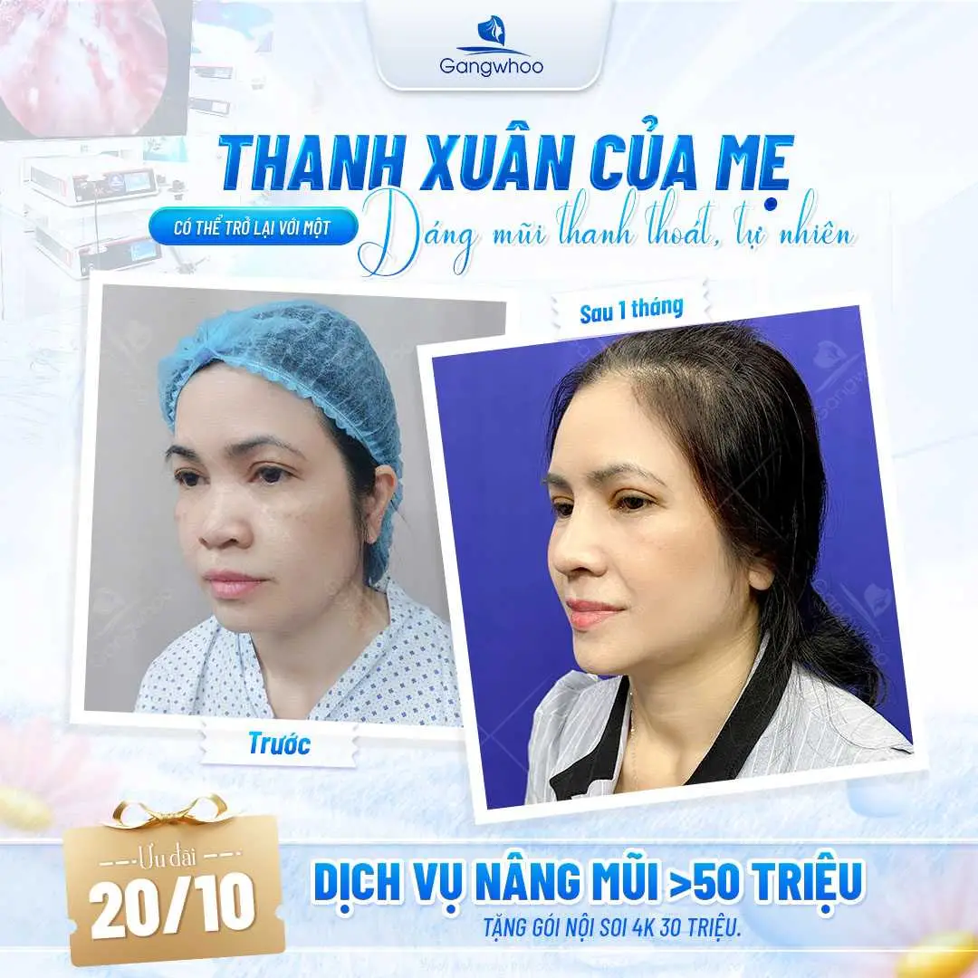 50 tuổi có nên nâng mũi không?