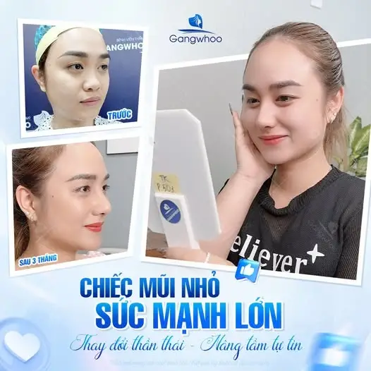 Bị cảm có nâng mũi được không?