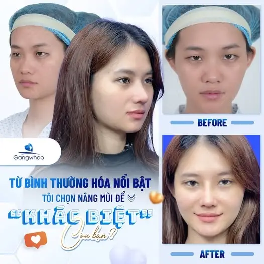 Những trường hợp nên cân nhắc trước khi nâng mũi