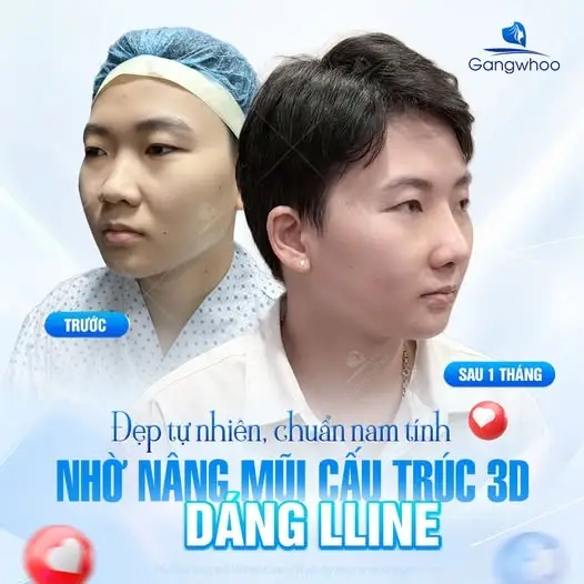 Dáng mũi L-Line
