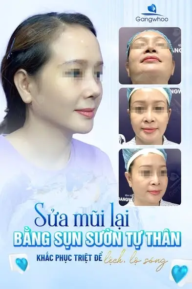 Nâng mũi bằng sụn tự thân