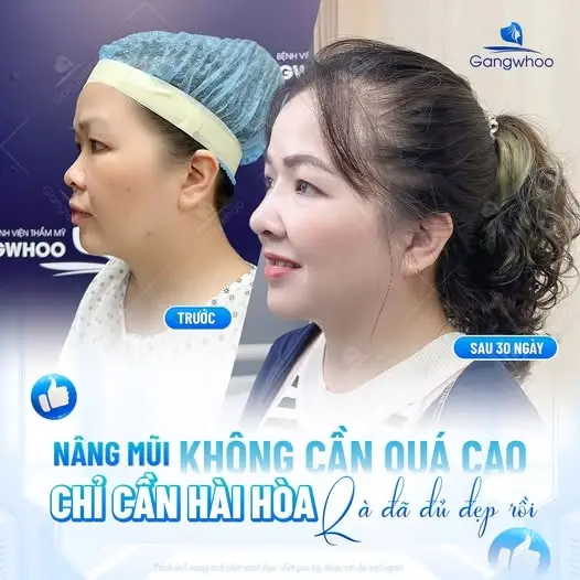 Các phương pháp nâng mũi không cần qua phẫu thuật
