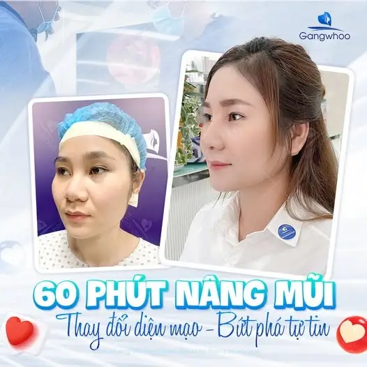 Vậy nên nâng mũi bằng phương pháp nào thì hiệu quả nhất?