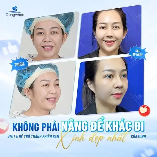 Lợi ích của việc massage sau khi nâng mũi