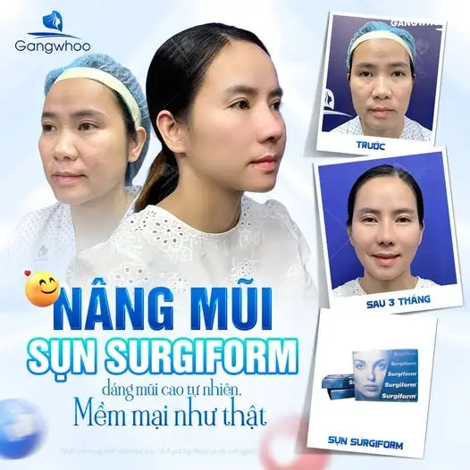 Nâng mũi bằng sụn nhân tạo