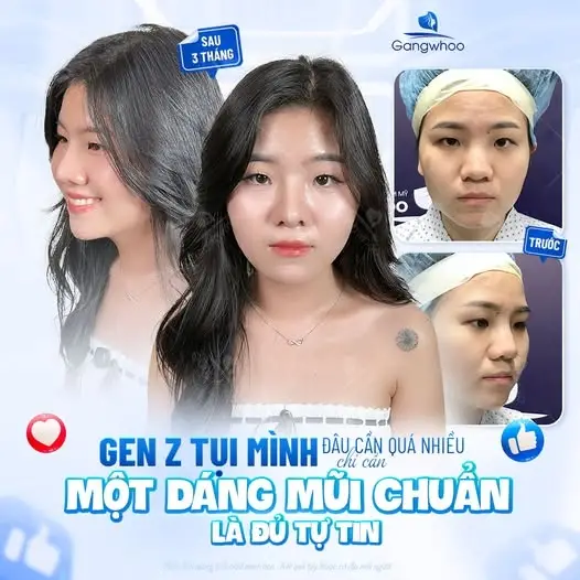 Cách nâng mũi bằng thìa có hiệu quả không?