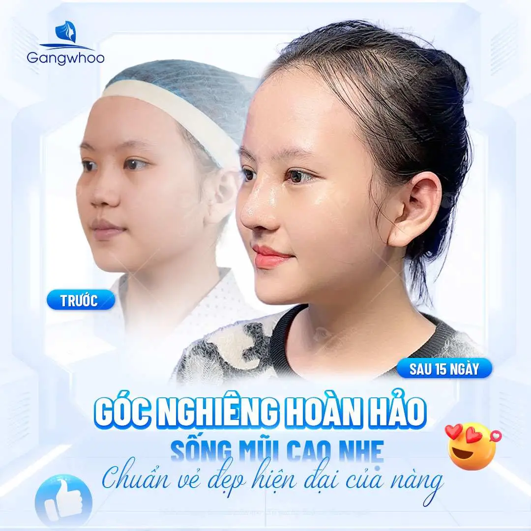 Những cảm giác sau khi nâng mũi thường gặp