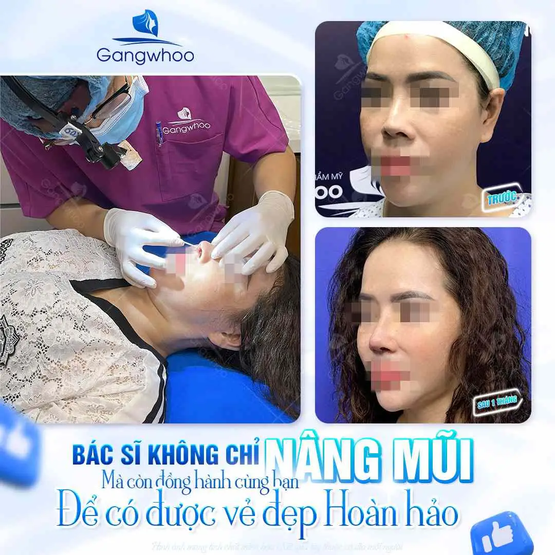 Sau 1 tháng thì mũi hoàn toàn ổn định và vô form
