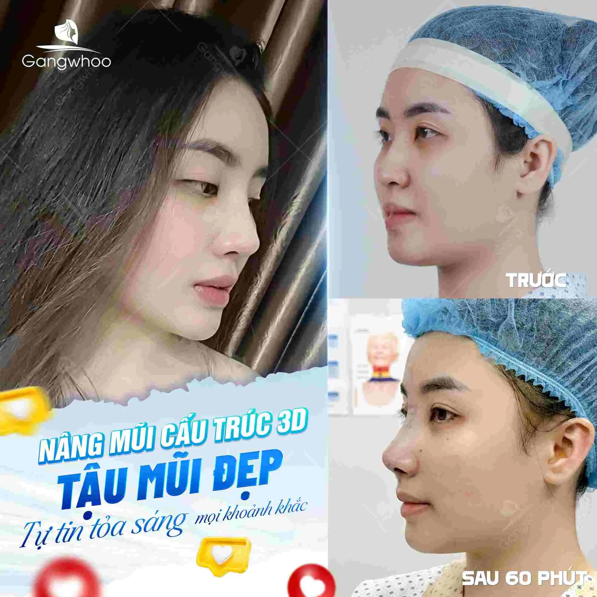 Có kinh có nâng mũi được không?