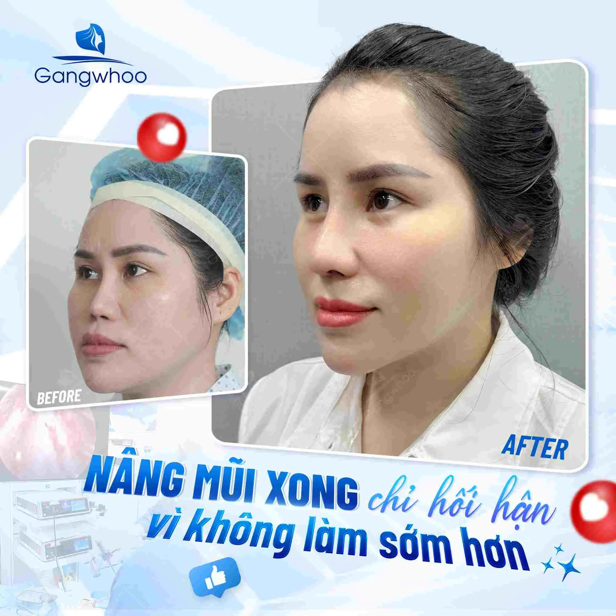 Sau khi hết kinh bao lâu thì mới được nâng mũi?