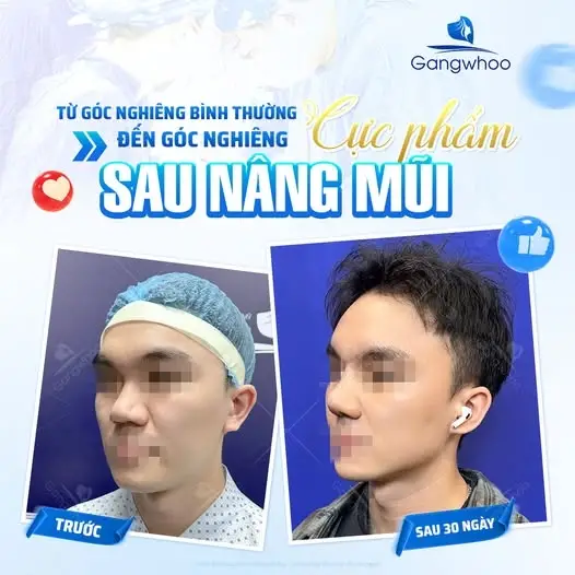 Nâng mũi bằng mỡ tự thân là gì?