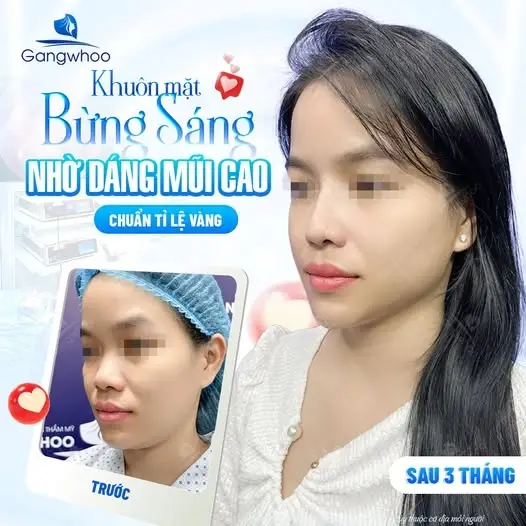 Có nên nâng mũi bằng mỡ tự thân?