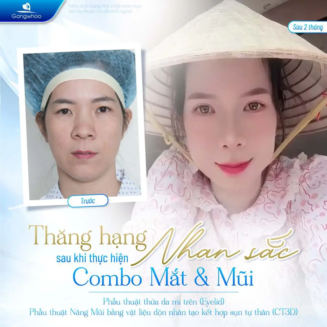 Có nên lựa chọn nâng mũi không?
