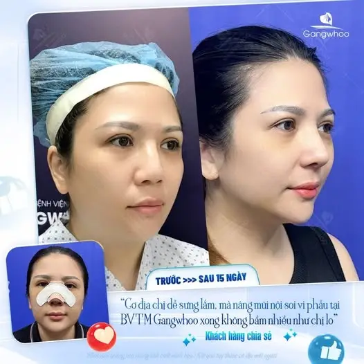 Nâng mũi bằng sụn nhân tạo