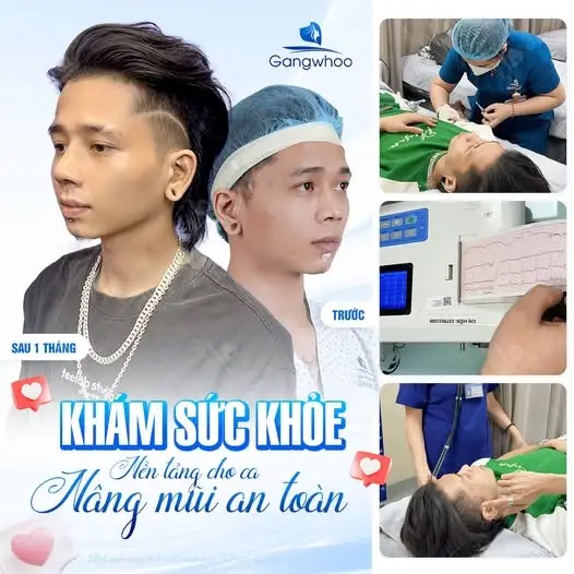 Ưu, nhược điểm khi thực hiện nâng mũi