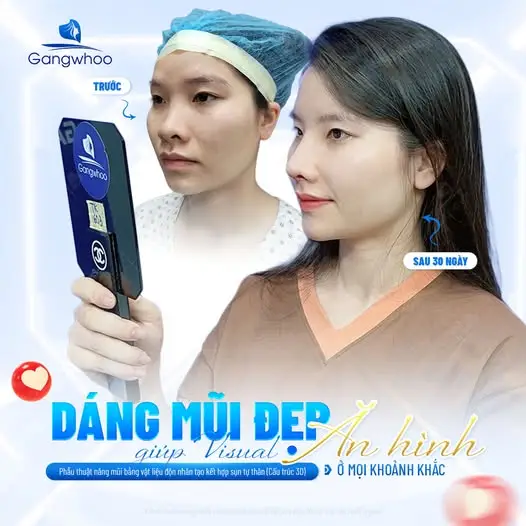 Có nên nâng mũi sau khi nâng ngực?