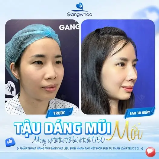 Bao lâu sau nâng ngực thì có thể nâng mũi?