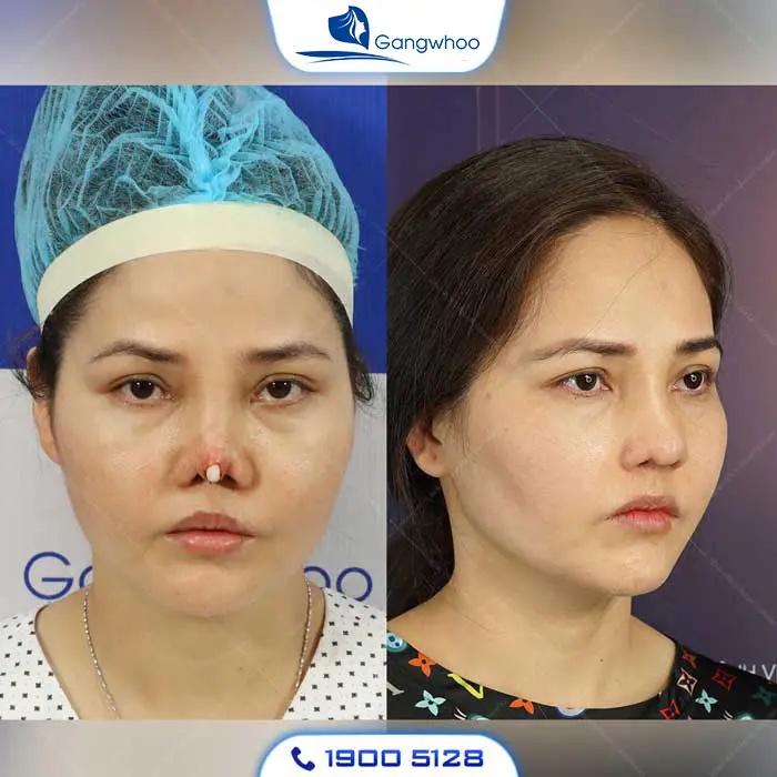 Dấu hiệu bị mưng mủ sau khi nâng mũi