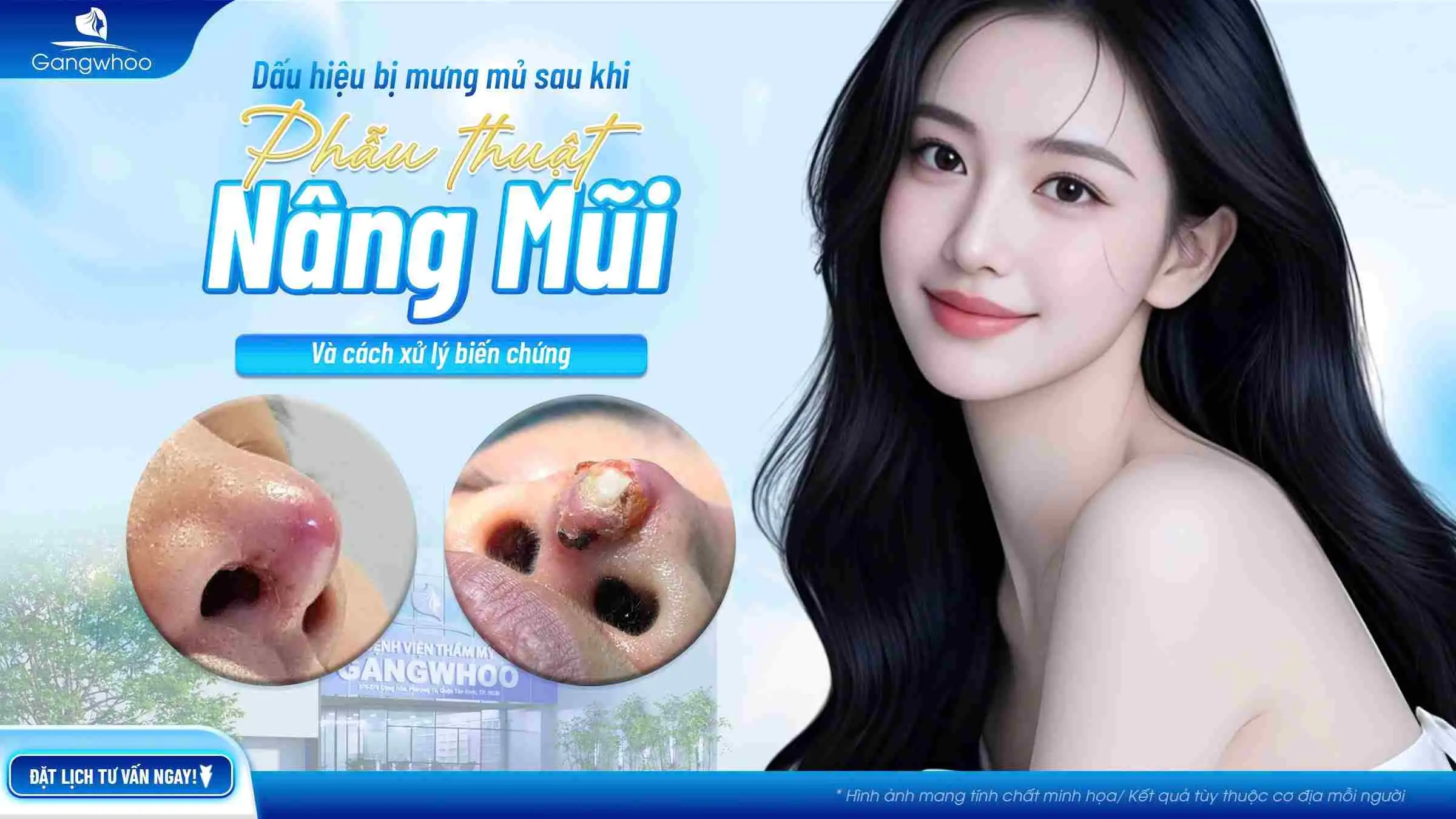 Dấu Hiệu Bị Mưng Mủ Sau Khi Nâng Mũi Và Cách Xử Lý Biến Chứng