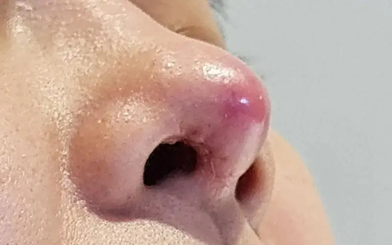 Các mức độ mưng mủ và cách xử lý đúng cách