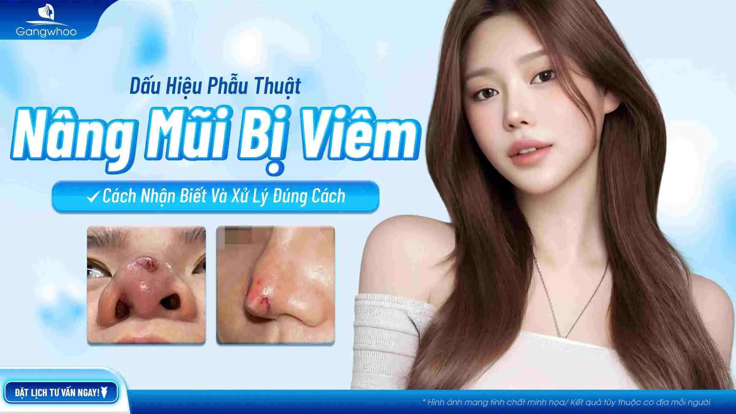 Dấu Hiệu Nâng Mũi Bị Viêm: Cách Nhận Biết Và Xử Lý Đúng Cách