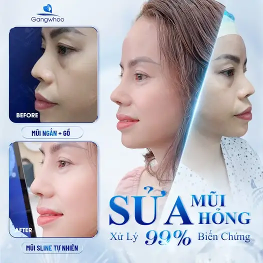 Nguyên nhân gây viêm sau nâng mũi