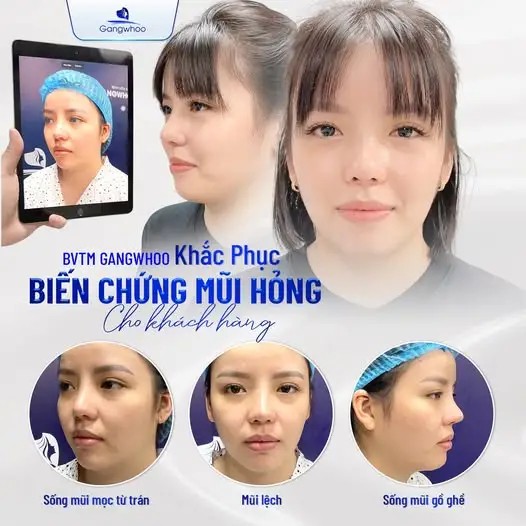 Cách xử lý chuẩn y khoa khi nâng mũi bị viêm