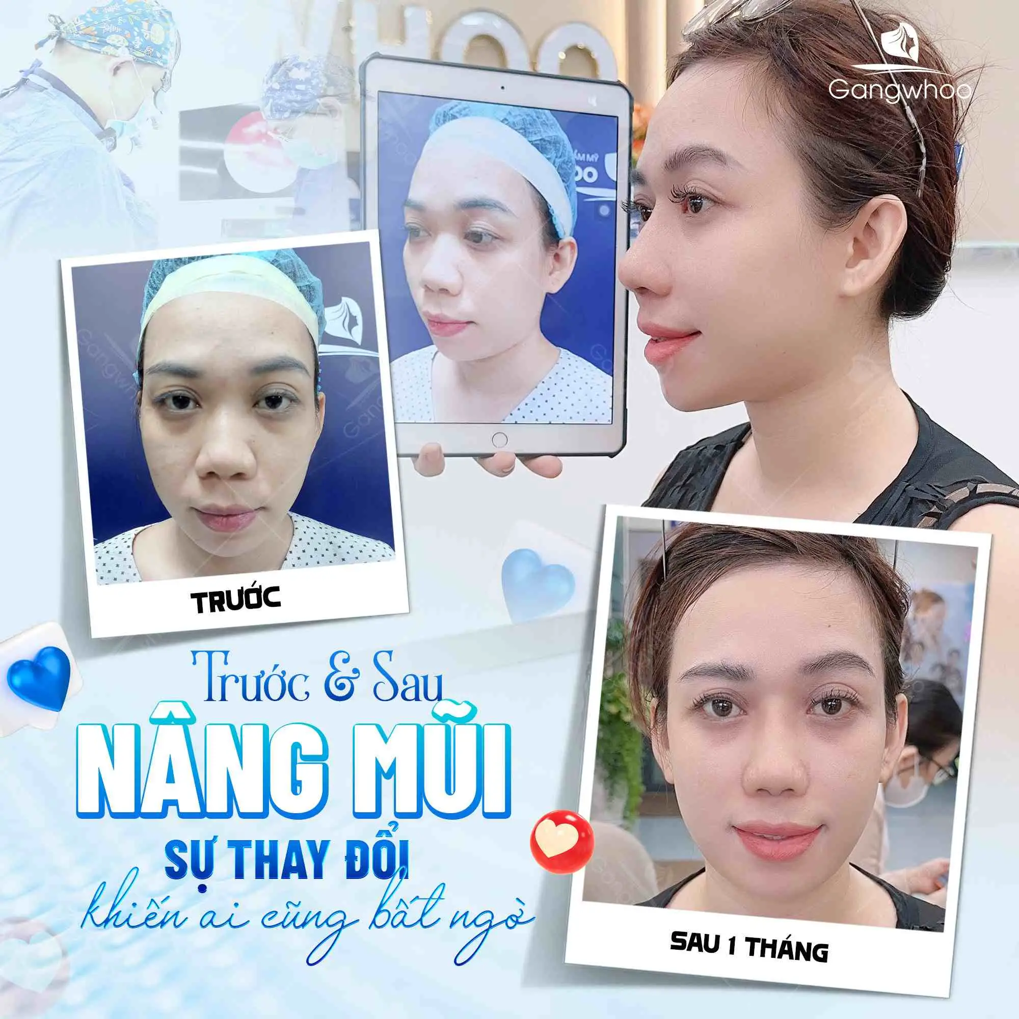 Nguyên nhân làm cho đầu mũi to sau khi nâng