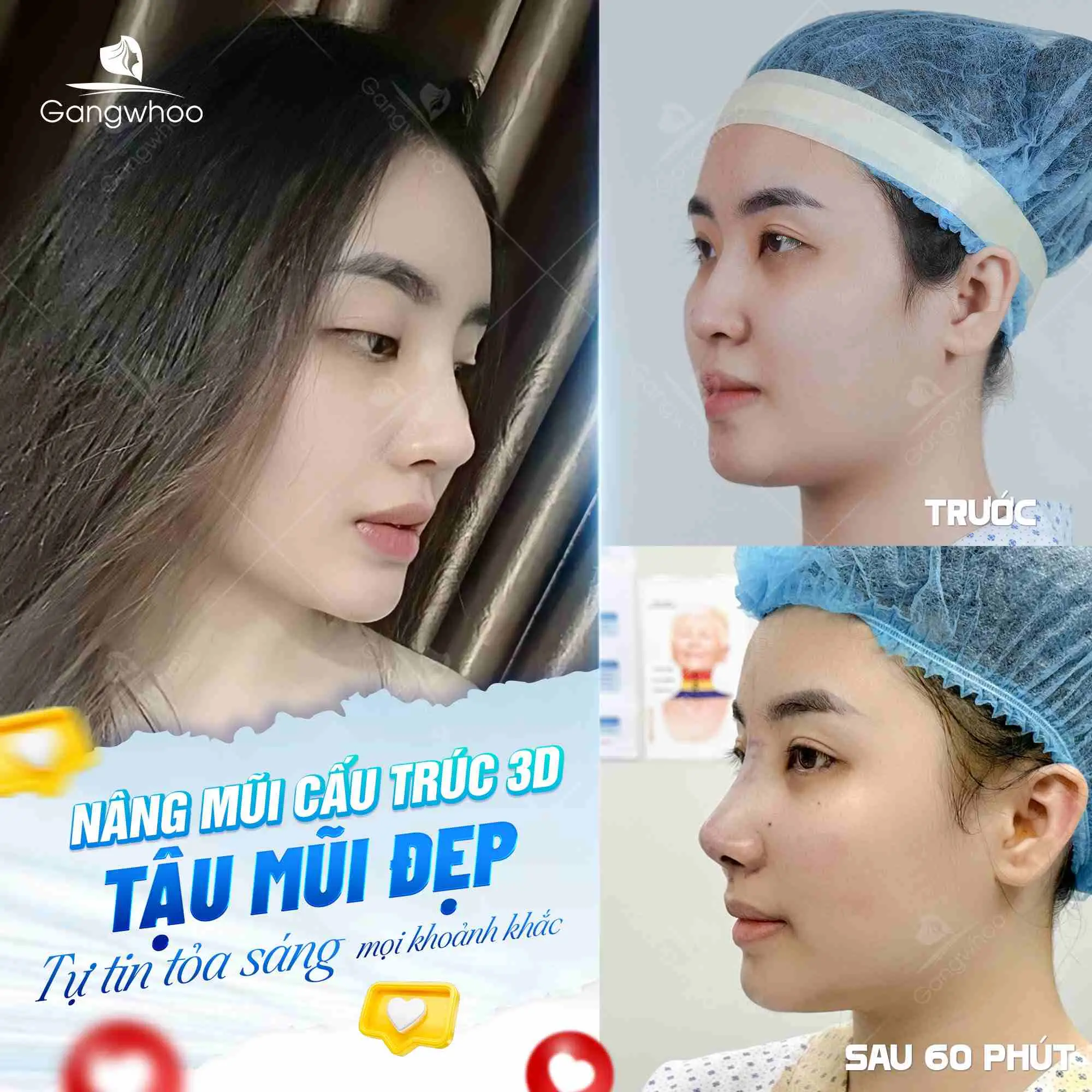 Cách khắc phục đầu mũi to sau khi nâng