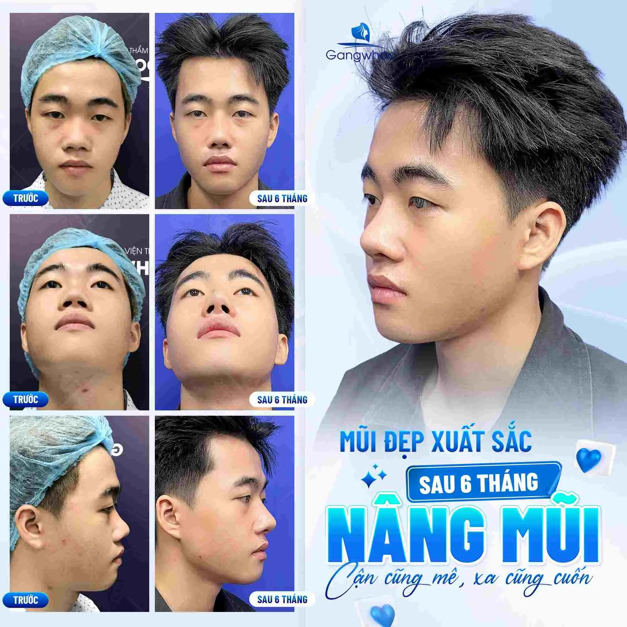 Chọn dáng mũi phù hợp với cấu trúc khuôn mặt