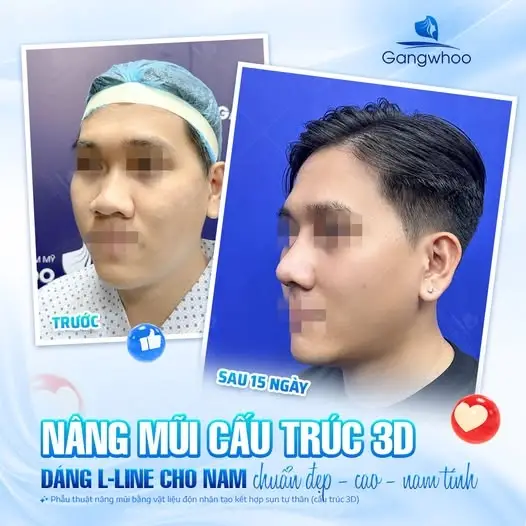 Dáng mũi L-Line