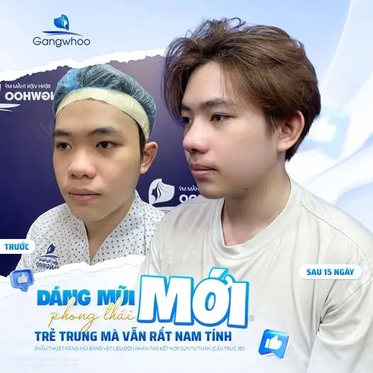 Nâng mũi cấu trúc