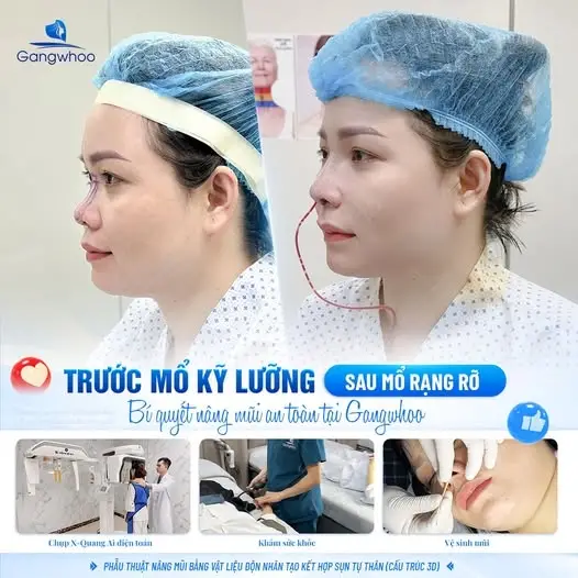 Lựa chọn dáng mũi phù hợp