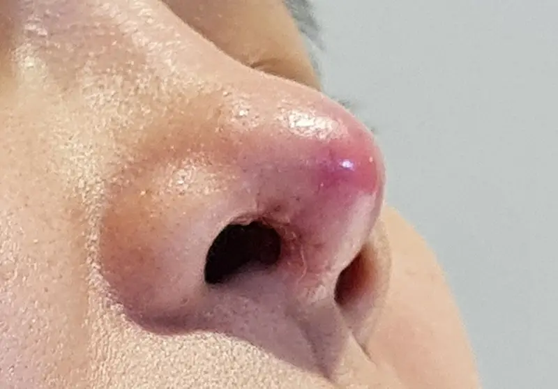 Dấu hiệu nhận biết dị ứng sóng mũi do nâng mũi