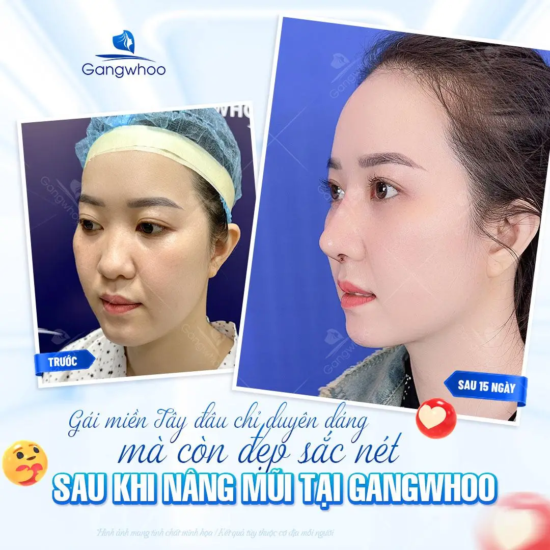 Khi nào nên dùng và khi nào không nên dùng dụng cụ nâng chỉnh mũi?