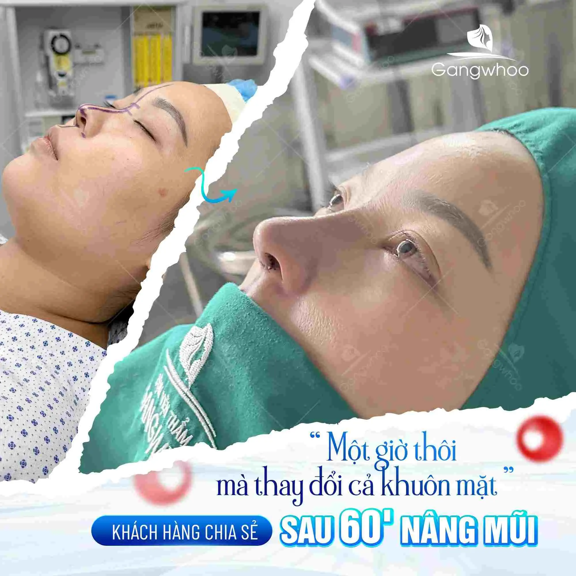Mang thai có nâng mũi được không?