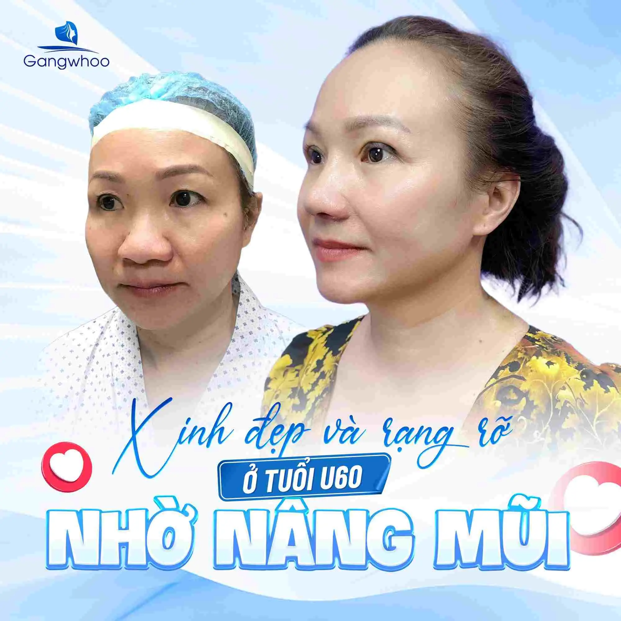 Những trường hợp khác không nên nâng mũi cần phải biết