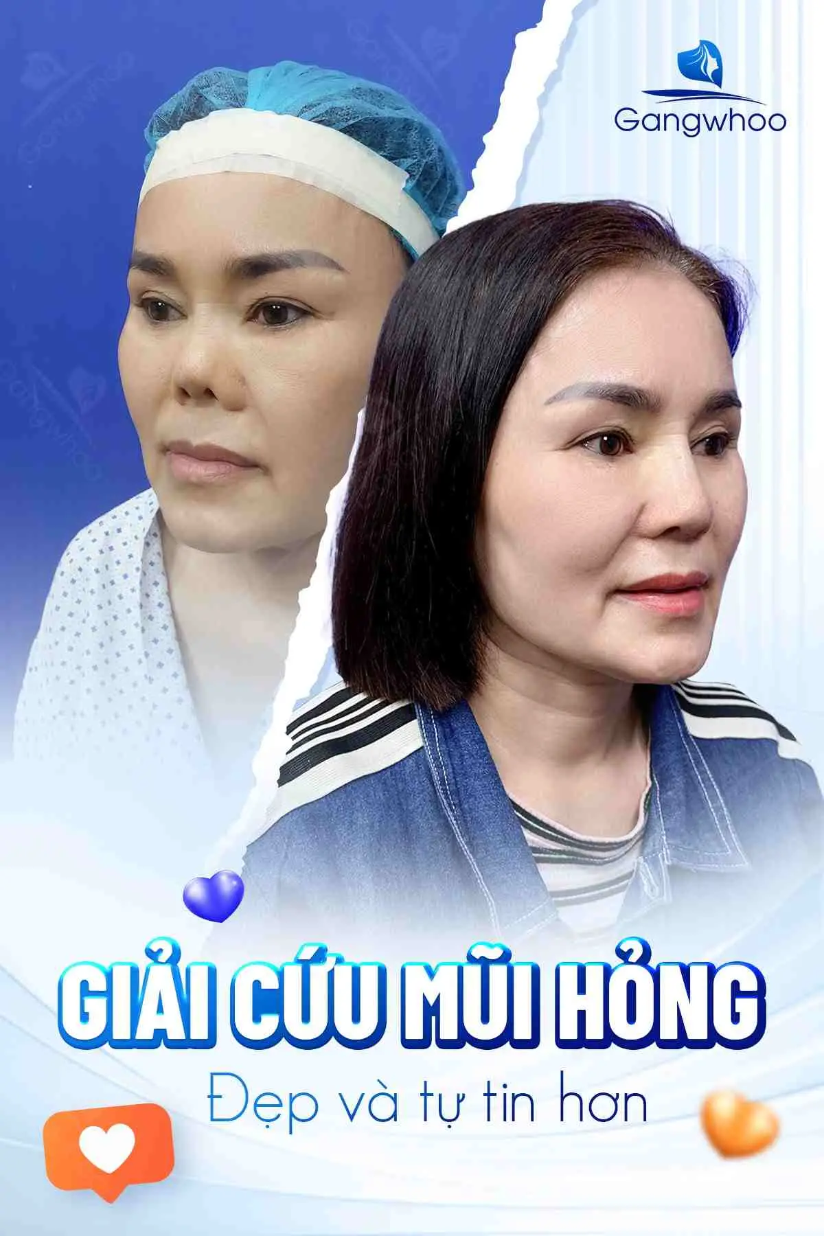 Nhiễm trùng sau nâng mũi nguy hiểm như thế nào?