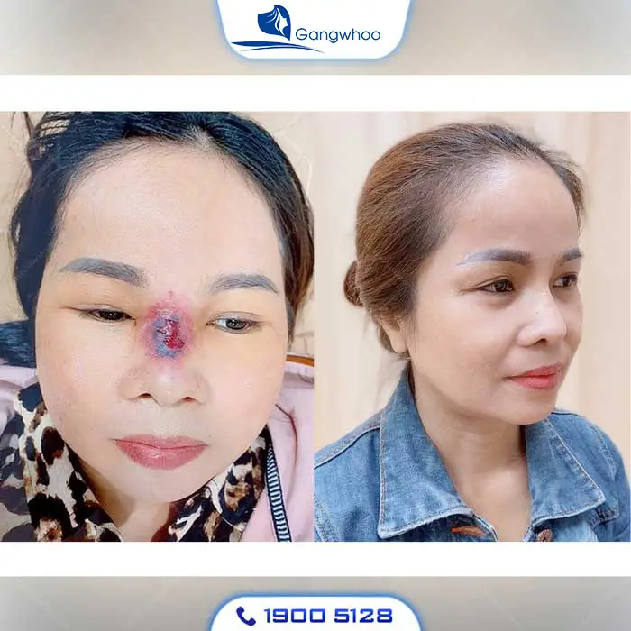 Dấu hiệu nhiễm trùng sau khi nâng mũi