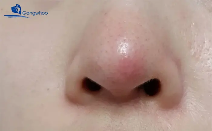Da mũi đổi màu bất thường