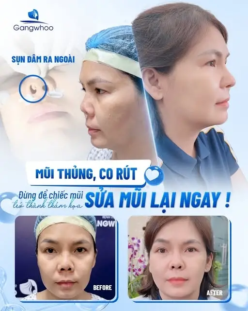 Cách điều trị nhiễm trùng sau nâng mũi (theo mức độ)