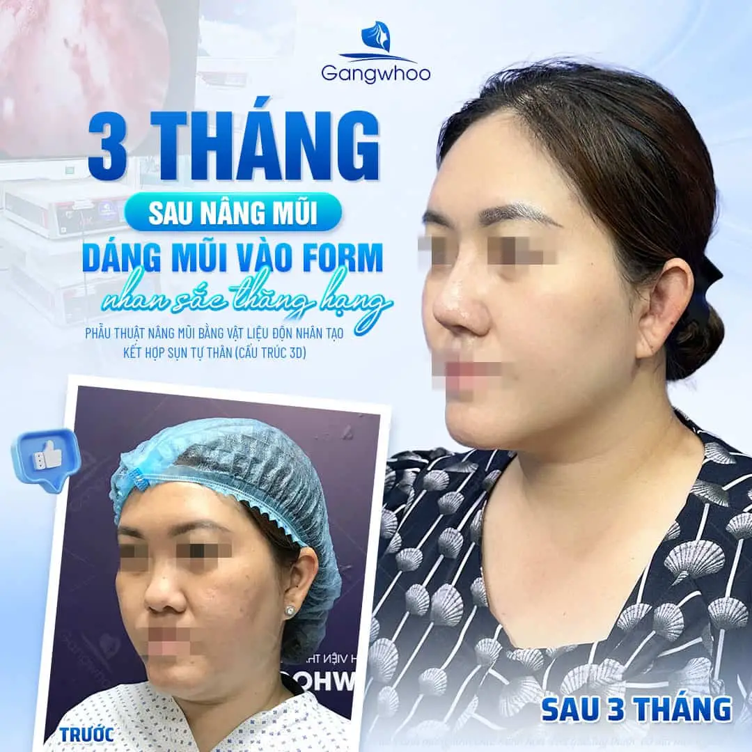 Những hậu quả của nâng mũi khi về già