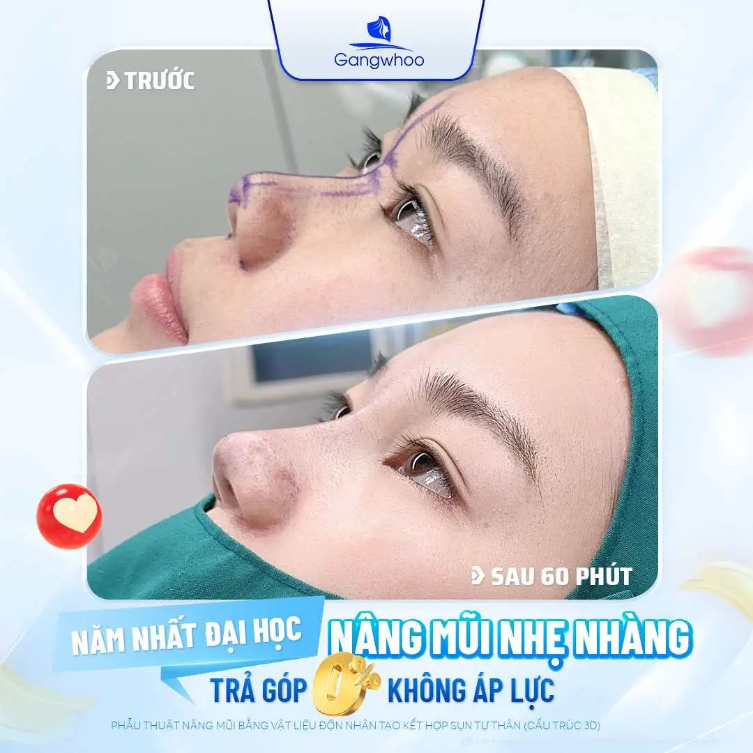 Lựa chọn phương pháp nâng mũi phù hợp