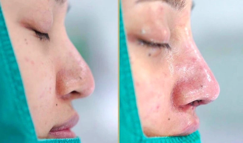 Đầu mũi mỏng và bóng đỏ